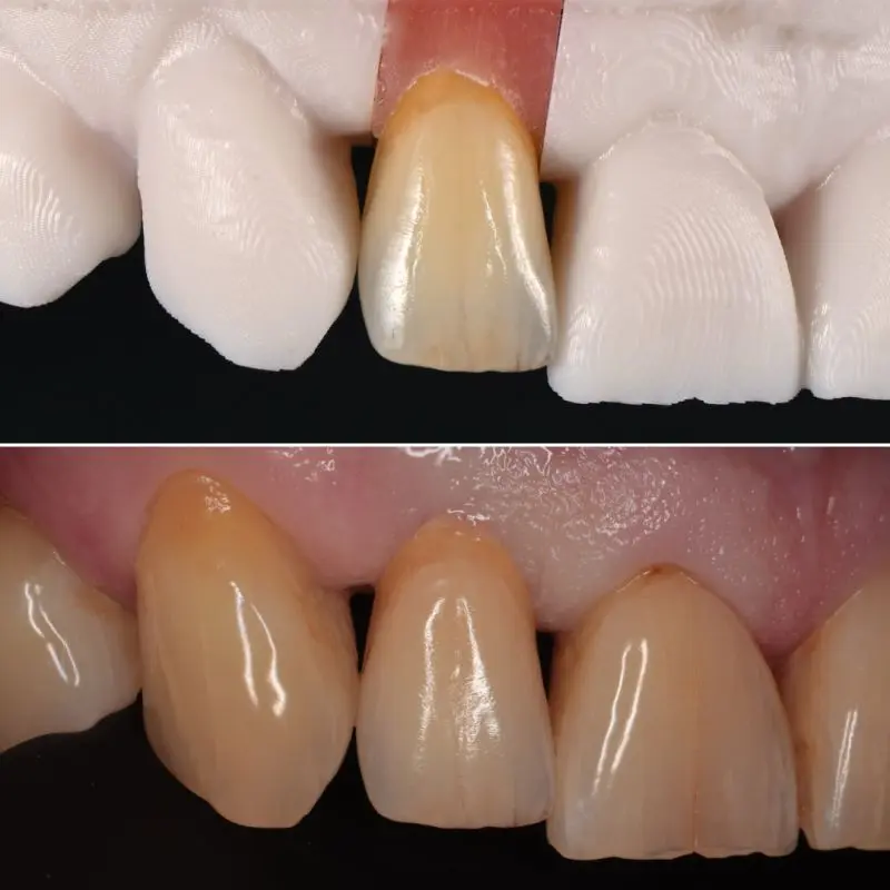 Kroon/brug voorbeeld 1