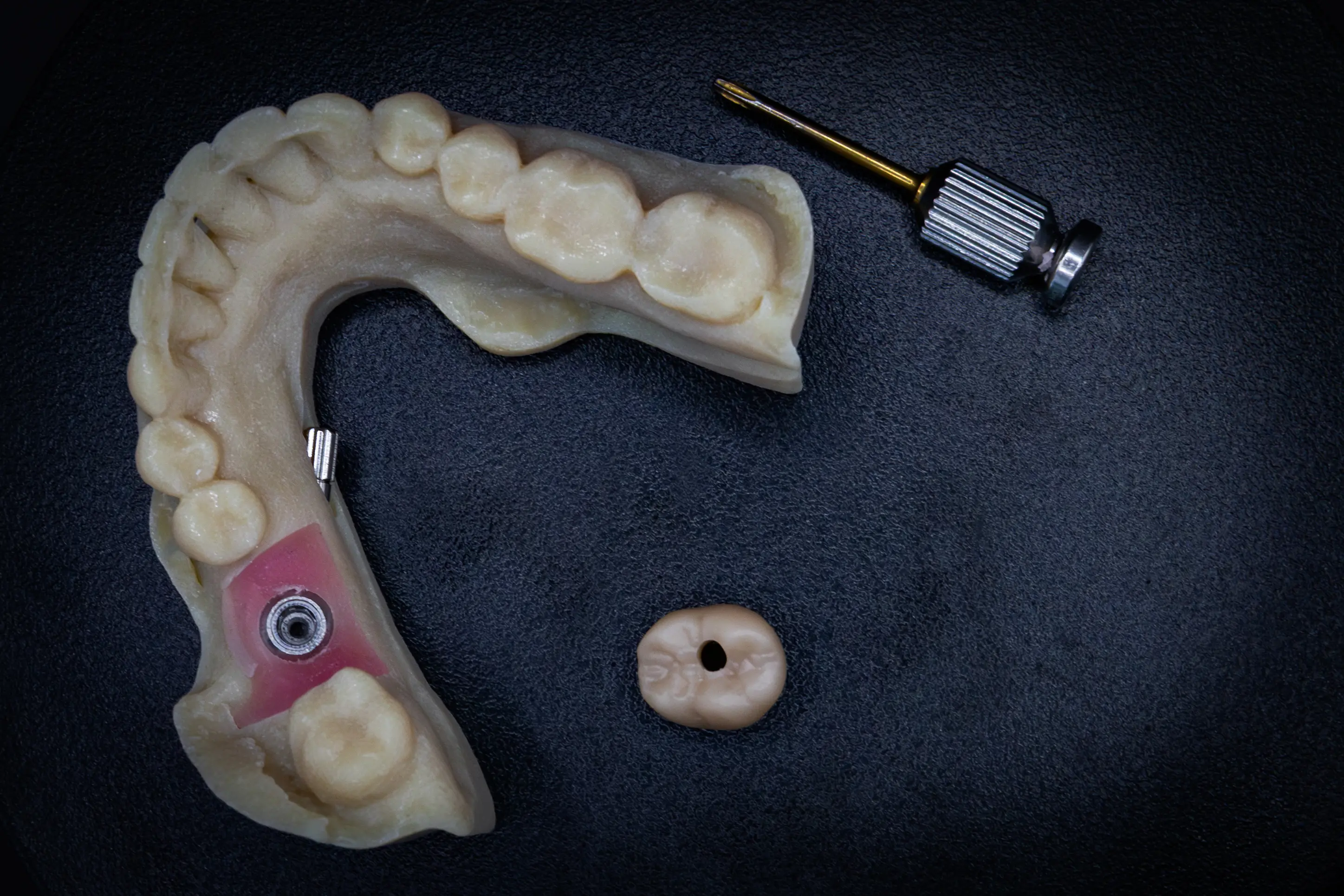 Implantaatwerk voorbeeld 3