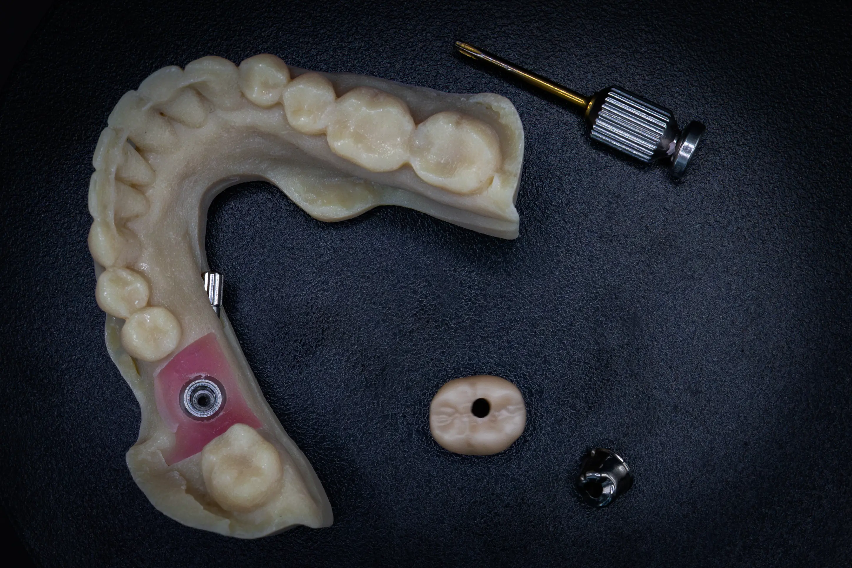 Implantaatwerk voorbeeld 4