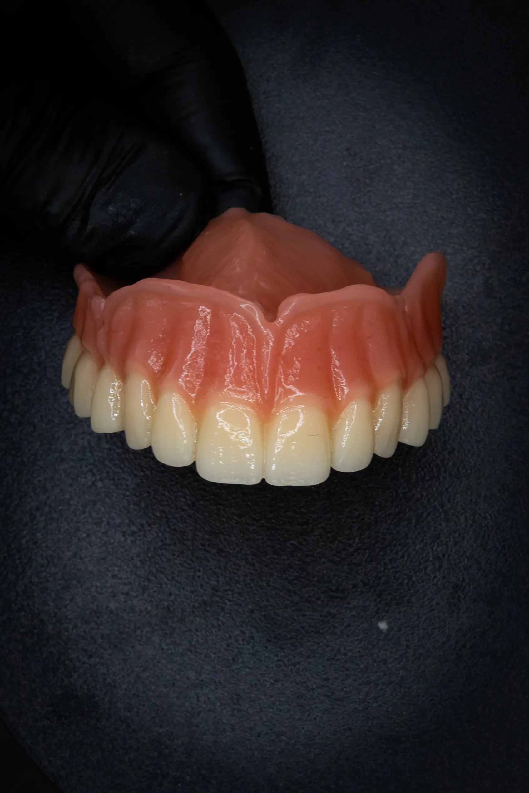 Afgewerkte digitale prothese – voorbeeld 2