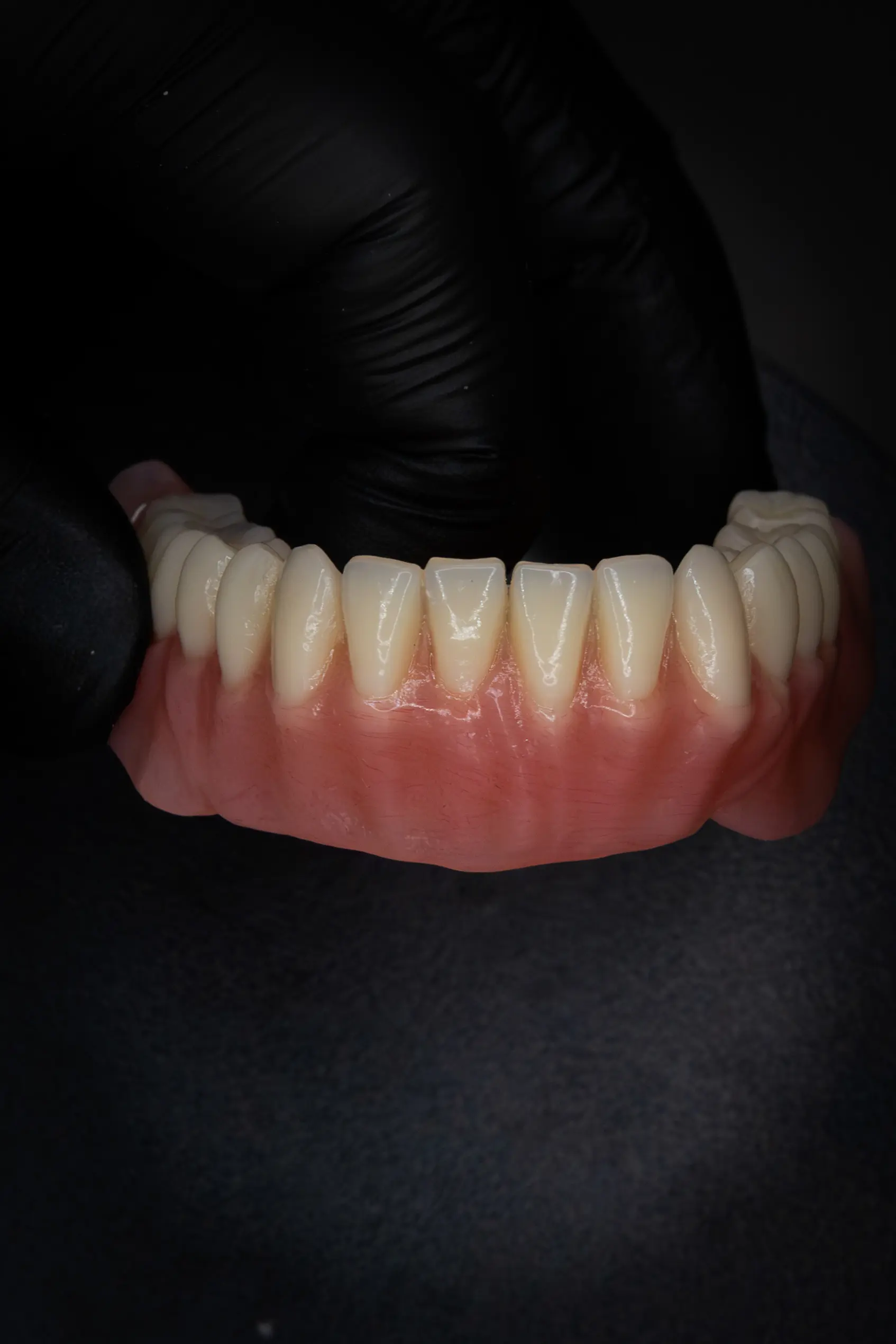 Afgewerkte digitale prothese – voorbeeld 3