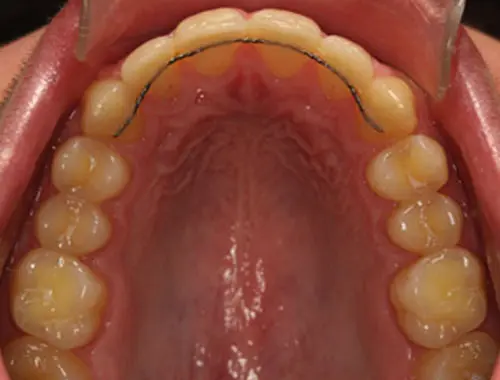 CC retainer (vaste spalk)