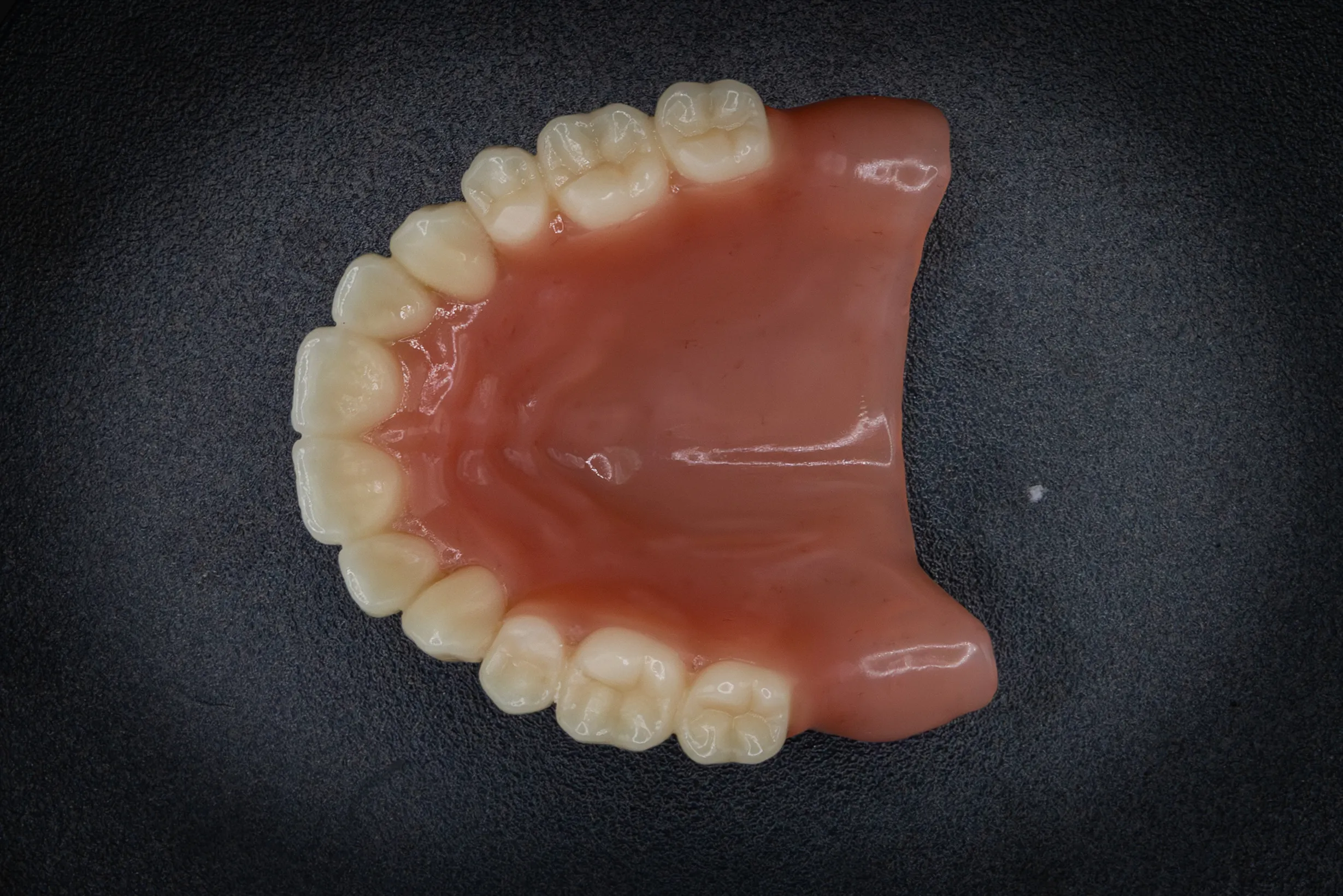 Afgewerkte digitale prothese – voorbeeld 1