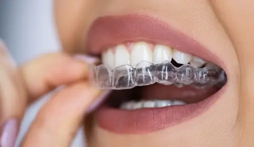 Aligner voorbeeld